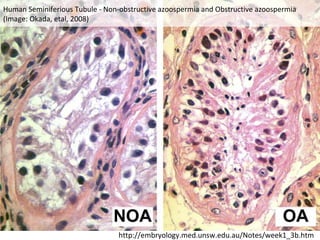 Human Seminiferious Tubule - Non-obstructive azoospermia and Obstructive azoospermia
(Image: Okada, etal, 2008)

http://embryology.med.unsw.edu.au/Notes/week1_3b.htm

 