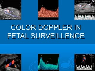 COLOR DOPPLER IN
FETAL SURVEILLENCE
 