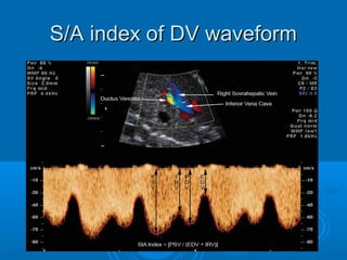 S/A index of DV waveform
 