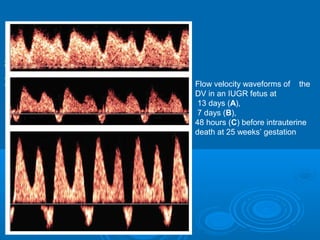 
 Flow velocity waveforms of the
DV in an IUGR fetus at
13 days (A),
7 days (B),
48 hours (C) before intrauterine
death at 25 weeks’ gestation
 