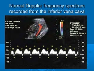 Normal Doppler frequency spectrum
recorded from the inferior vena cava
 