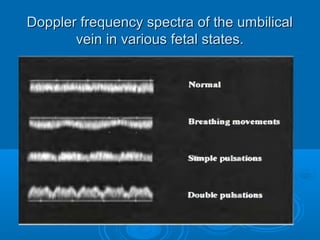Doppler frequency spectra of the umbilical
vein in various fetal states.
 