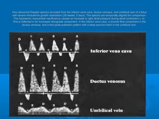 Very abnormal Doppler spectra recorded from the inferior vena cava, ductus venosus, and umbilical vein of a fetus with
severe intrauterine growth retardation (28 weeks, 5 days). The spectra are temporally aligned for comparison.
The hypoxemic myocardial~nsufficiency causes an increase in right atrial pressure during atrial contraction (- a).
This is reflected in an increased retrograde component in the inferior vena cava. a reverse flow component in the
ductus venosus. and a twin-peak pulsation pattern with a deep second notch in the umbilical vein.
 