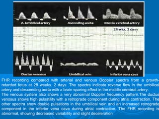 FHR recording compared with arterial and venous Doppler spectra from a growth-
retarded fetus at 28 weeks. 2 days. The spectra indicate reverse flow in the umbilical
artery and descending aorta with a brain-sparing effect in the middle cerebral artery.
The venous system also shows a very abnormal Doppler frequency pattern.The ductus
venosus shows high pulsatility with a retrograde component during atrial contraction. The
other spectra show double pulsations in the umbilical vein and an increased retrograde
component in the inferior vena cava during atrial contraction. The FHR recording is
abnormal, showing decreased variability and slight deceleration
 