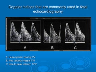 Doppler indices that are commonly used in fetal
echocardiography
A, Peak-systolic velocity PV
B, time velocity integral TVI
C, time-to peak velocity TPV
 