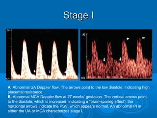 Stage I
A, Abnormal UA Doppler flow. The arrows point to the low diastole, indicating high
placental resistance.
B, Abnormal MCA Doppler flow at 27 weeks’ gestation. The vertical arrows point
to the diastole, which is increased, indicating a “brain-sparing effect”; the
horizontal arrows indicate the PSV, which appears normal. An abnormal PI in
either the UA or MCA characterizes stage I.
 