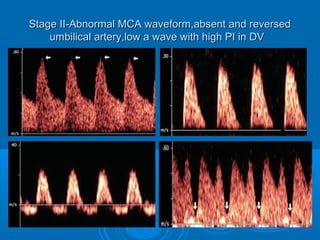 Stage II-Abnormal MCA waveform,absent and reversed
umbilical artery,low a wave with high PI in DV
 