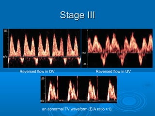 Stage III
Reversed flow in DV Reversed flow in UV
an abnormal TV waveform (E/A ratio >1).
 