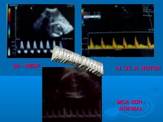 UA - REDF Lf. UT. A. NOTCH
MCA SDR -
NORMAL
 