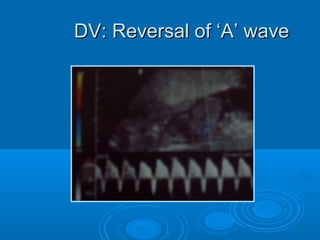 DV: Reversal of ‘A’ wave
 