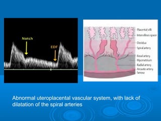 Abnormal uteroplacental vascular system, with lack of
dilatation of the spiral arteries
 