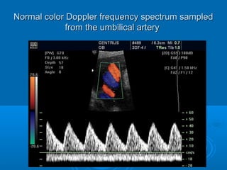 Normal color Doppler frequency spectrum sampled
from the umbilical artery
 