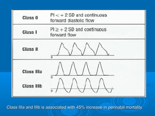 Class IIIa and IIIb is associated with 45% increase in perinatal mortality
 