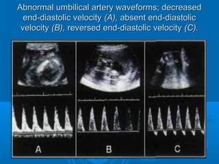 Abnormal umbilical artery waveforms; decreased
end-diastolic velocity (A), absent end-diastolic
velocity (B), reversed end-diastolic velocity (C).
 