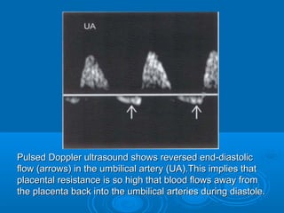Pulsed Doppler ultrasound shows reversed end-diastolic
flow (arrows) in the umbilical artery (UA).This implies that
placental resistance is so high that blood flows away from
the placenta back into the umbilical arteries during diastole.
 