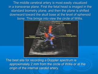 The middle cerebral artery is most easily visualized
in a transverse plane. First the fetal head is imaged in the
standard biometry plane, and then the plane is shifted
downward toward the skull base at the level of sphenoid
bone. This brings into view the circle of Willis.
The best site for recording a Doppler spectrum is
approximately 2 mm from the circle of Willis or at the origin
of the internal carotid artery.
 