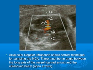  Axial color Doppler ultrasound shows correct technique
for sampling the MCA. There must be no angle between
the long axis of the vessel (curved arrow) and the
ultrasound beam (open arrows).
 