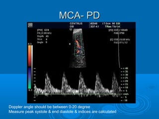 MCA- PD
Doppler angle should be between 0-20 degree
Measure peak systole & end diastole & indices are calculated
 