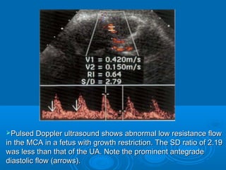  Pulsed Doppler ultrasound shows abnormal low resistance
flow in the MCA in a fetus with growth restriction. The SD ratio
of 2.19 was less than that of the UA. Note the prominent
antegrade diastolic flow (arrows).
 