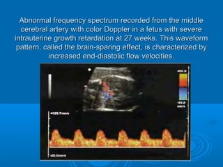 Abnormal frequency spectrum recorded from the middle
cerebral artery with color Doppler in a fetus with severe
intrauterine growth retardation at 27 weeks. This waveform
pattern, called the brain-sparing effect, is characterized by
increased end-diastolic flow velocities.
 
