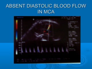 ABSENT DIASTOLIC BLOOD FLOW
IN MCA
 