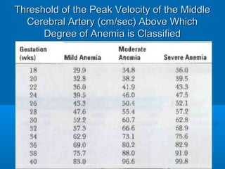 Threshold of the Peak Velocity of the Middle
Cerebral Artery (cm/sec) Above Which
Degree of Anemia is Classified
 