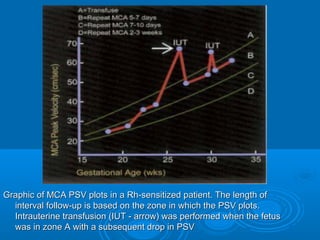 Graphic of MCA PSV plots in a Rh-sensitized patient. The length of
interval follow-up is based on the zone in which the PSV plots.
Intrauterine transfusion (IUT - arrow) was performed when the fetus
was in zone A with a subsequent drop in PSV
 