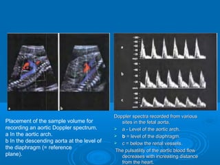 Doppler spectra recorded from various
sites in the fetal aorta.
 a - Level of the aortic arch.
 b = level of the diaphragm.
 c = below the renal vessels.
The pulsatility of the aortic blood flow
decreases with increasing distance from
the heart.
Placement of the sample volume for
recording an aortic Doppler spectrum.
a In the aortic arch.
b In the descending aorta at the level of
the diaphragm (= reference
plane).
 