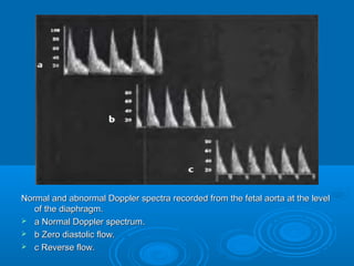 Normal and abnormal Doppler spectra recorded from the fetal aorta at the level
of the diaphragm.
 a Normal Doppler spectrum.
 b Zero diastolic flow.
 c Reverse flow.
 