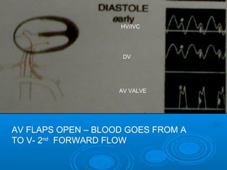 DV
AV VALVE
HV/IVC
AV FLAPS OPEN – BLOOD GOES FROM A
TO V- 2nd FORWARD FLOW
 