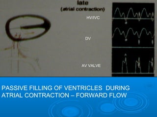 DV
HV/IVC
AV VALVE
PASSIVE FILLING OF VENTRICLES DURING
ATRIAL CONTRACTION – FORWARD FLOW
 