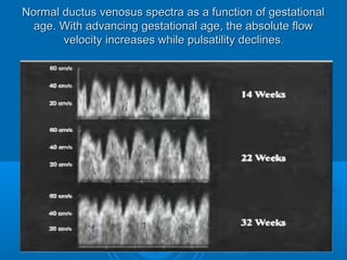 Normal ductus venosus spectra as a function of gestational
age. With advancing gestational age, the absolute flow
velocity increases while pulsatility declines.
 