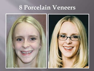 8 Porcelain Veneers
 