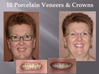 10 Porcelain Veneers & Crowns
 