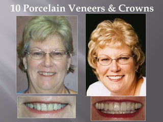 10 Porcelain Veneers & Crowns
 