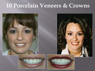10 Porcelain Veneers & Crowns
 