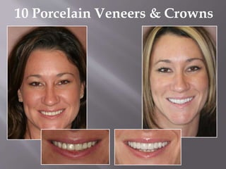 10 Porcelain Veneers & Crowns
 