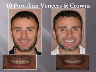 10 Porcelain Veneers & Crowns
 