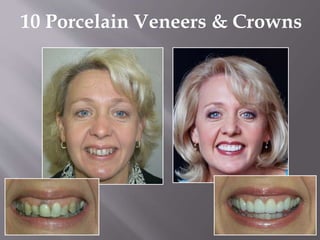 10 Porcelain Veneers & Crowns
 