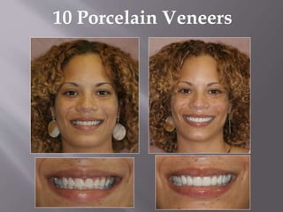 10 Porcelain Veneers
 