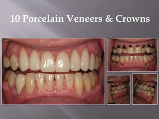 10 Porcelain Veneers & Crowns
 
