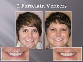 2 Porcelain Veneers
 