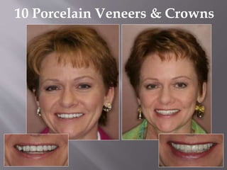 10 Porcelain Veneers & Crowns
 