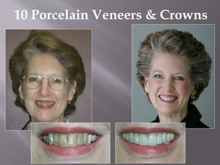 10 Porcelain Veneers & Crowns
 