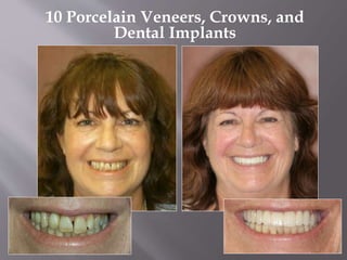 10 Porcelain Veneers, Crowns, and
Dental Implants
 