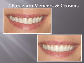 2 Porcelain Veneers & Crowns
 