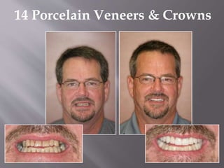 14 Porcelain Veneers & Crowns
 