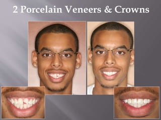 2 Porcelain Veneers & Crowns
 