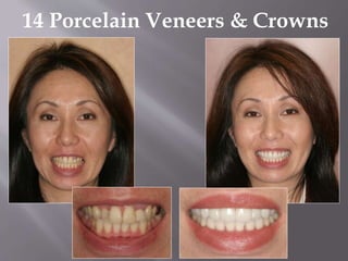 14 Porcelain Veneers & Crowns
 