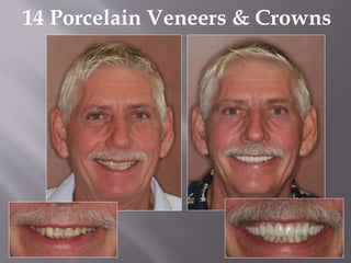 14 Porcelain Veneers & Crowns
 
